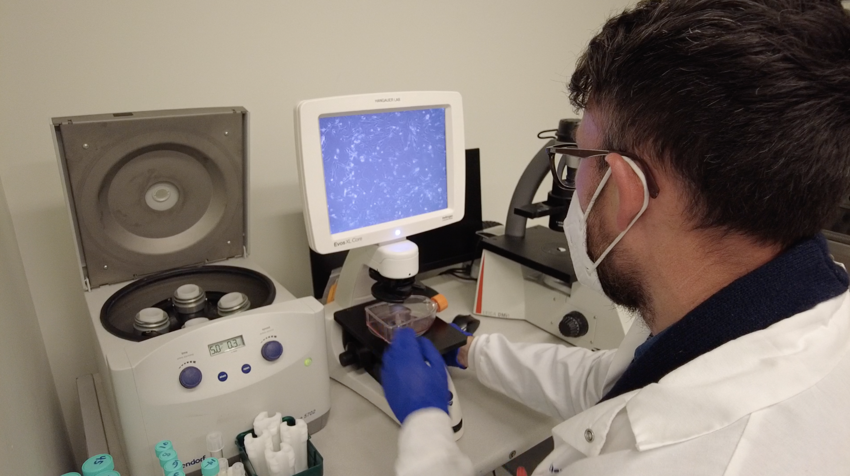 UCSD discovery could change acne treatment