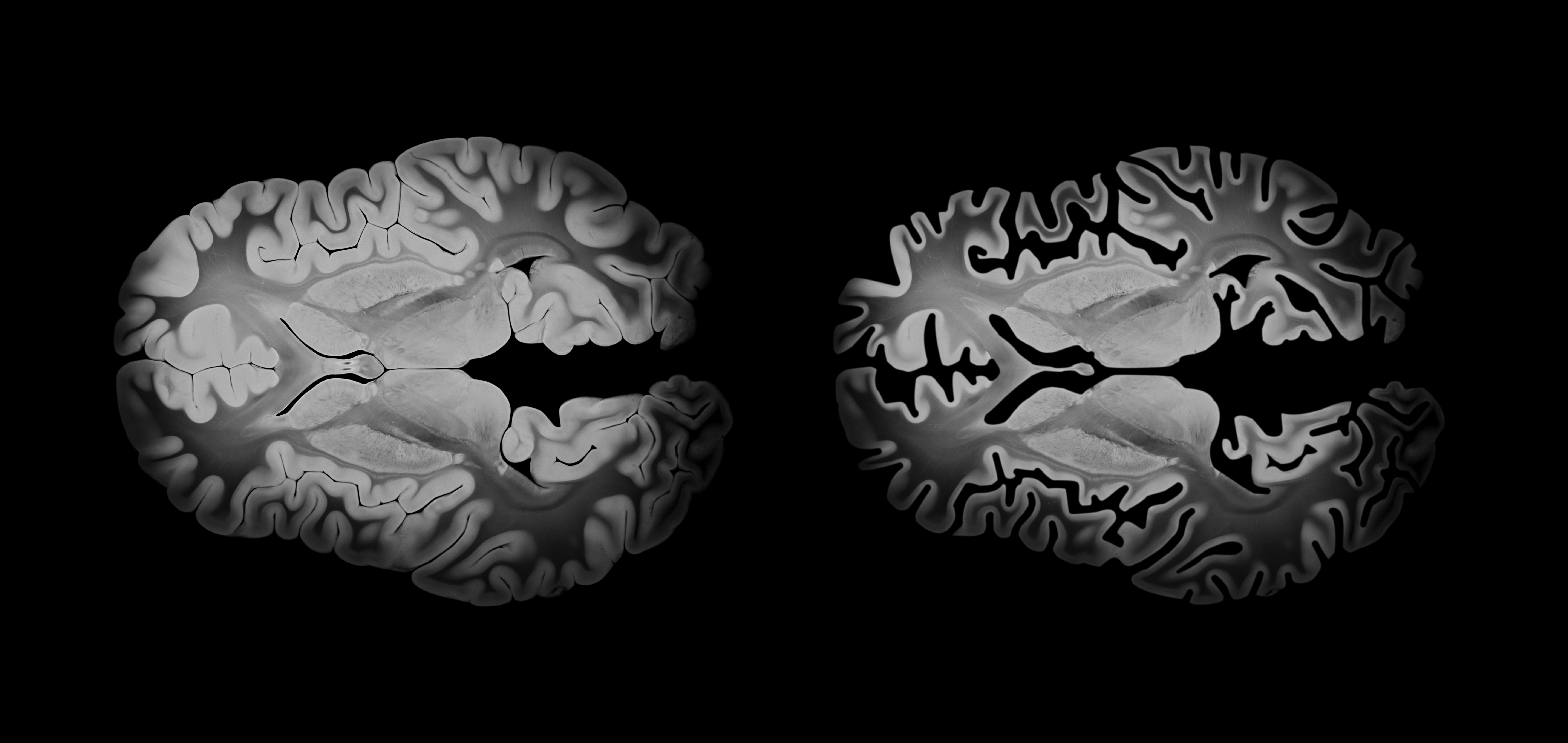 Alzheimer brain comparison in axial view showing differences between a healthy and affected brain, with cortical atrophy and neurodegeneration, displayed on a black background.