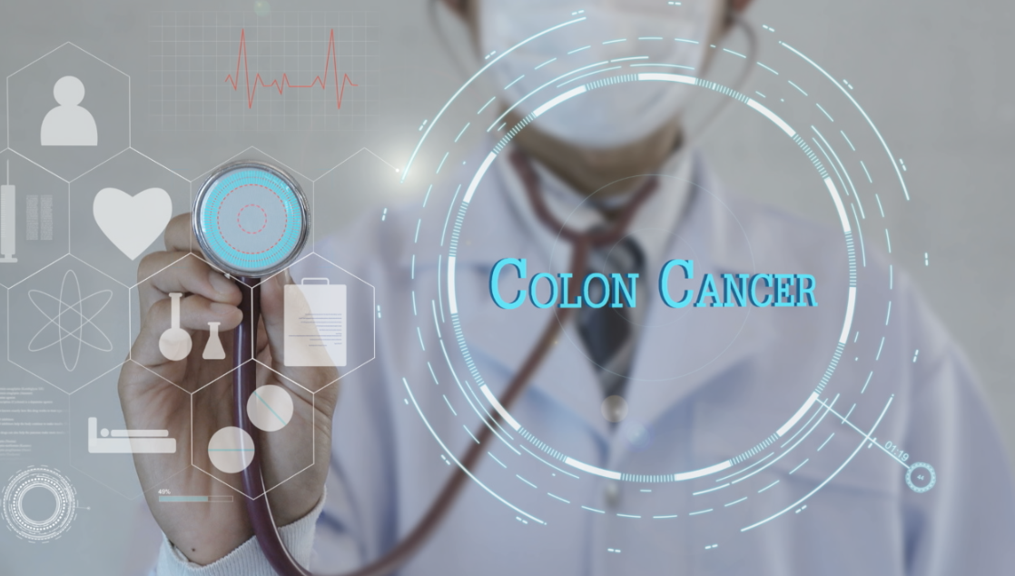 Colon Cancer 