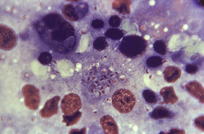 Histoplasmosis
