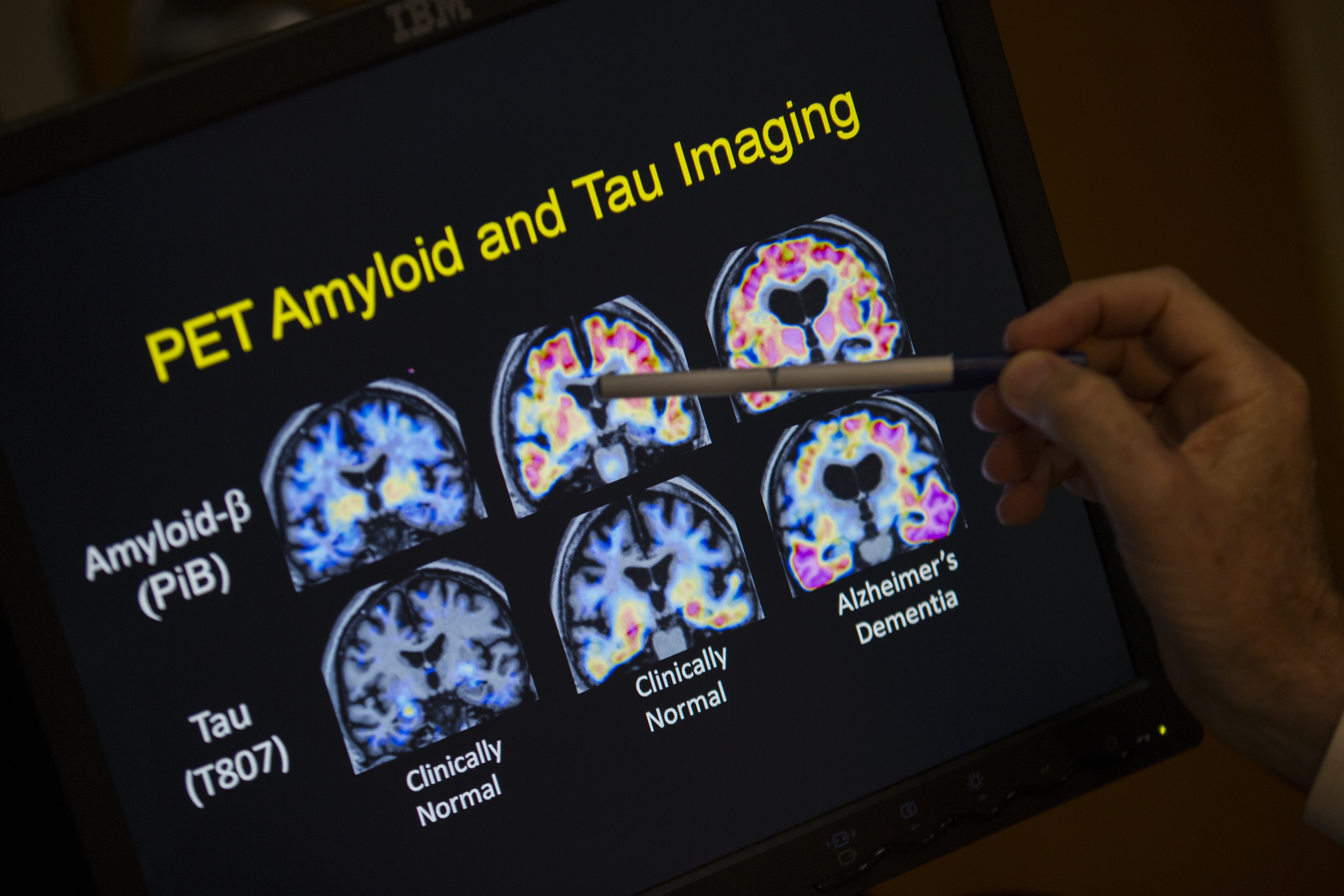 Brain scans that are part of a study on Alzheimer's disease.