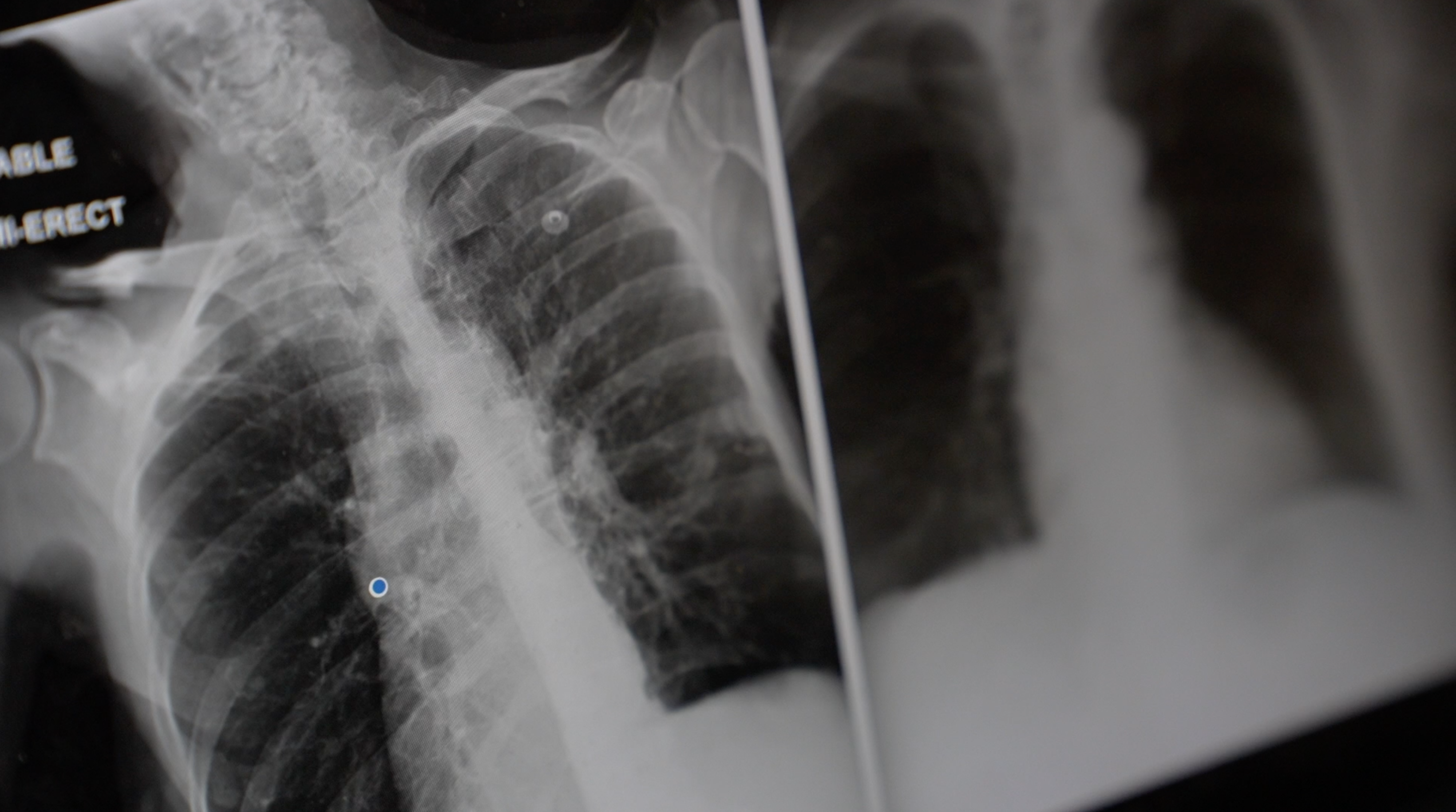 Study shows artificial intelligence deep learning models can detect race in medical imaging