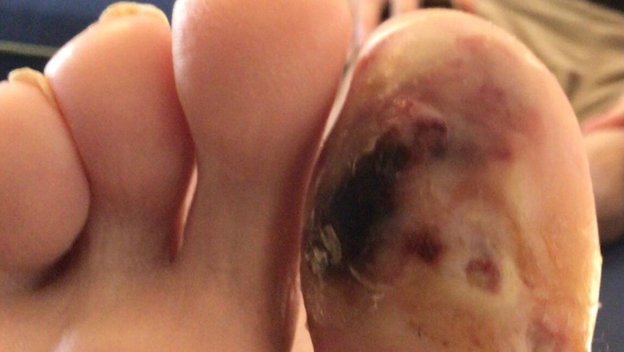 The frostbitten toe of John O'Connell.