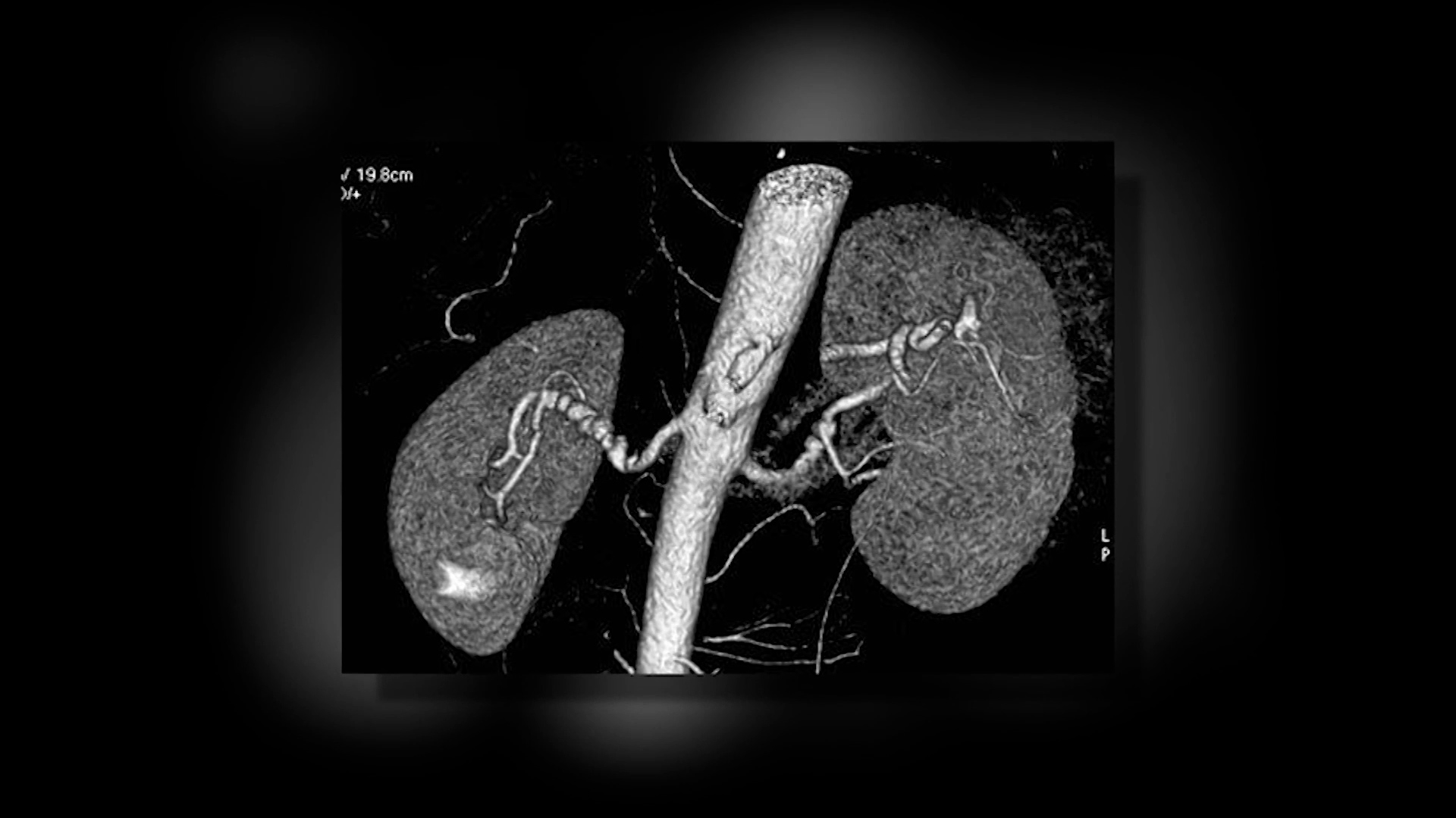 Kidney