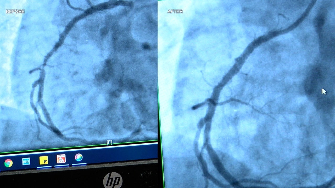 Shockwave-Intravascular-Lithotripsy-treatment-2-WFTS-KING.jpg