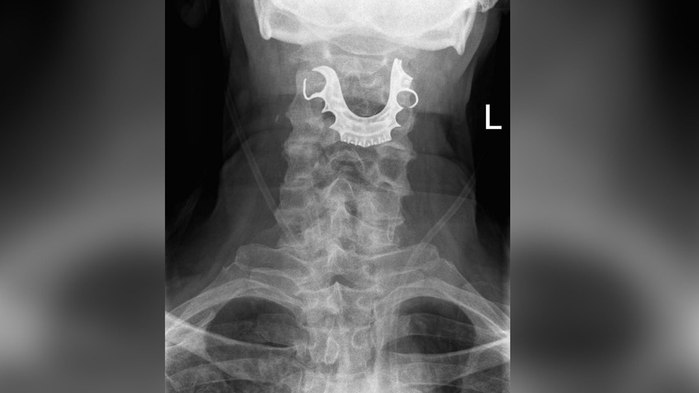 A 72-year-old's false teeth got stuck in his throat during surgery and weren't discovered for eight days, doctors have said.