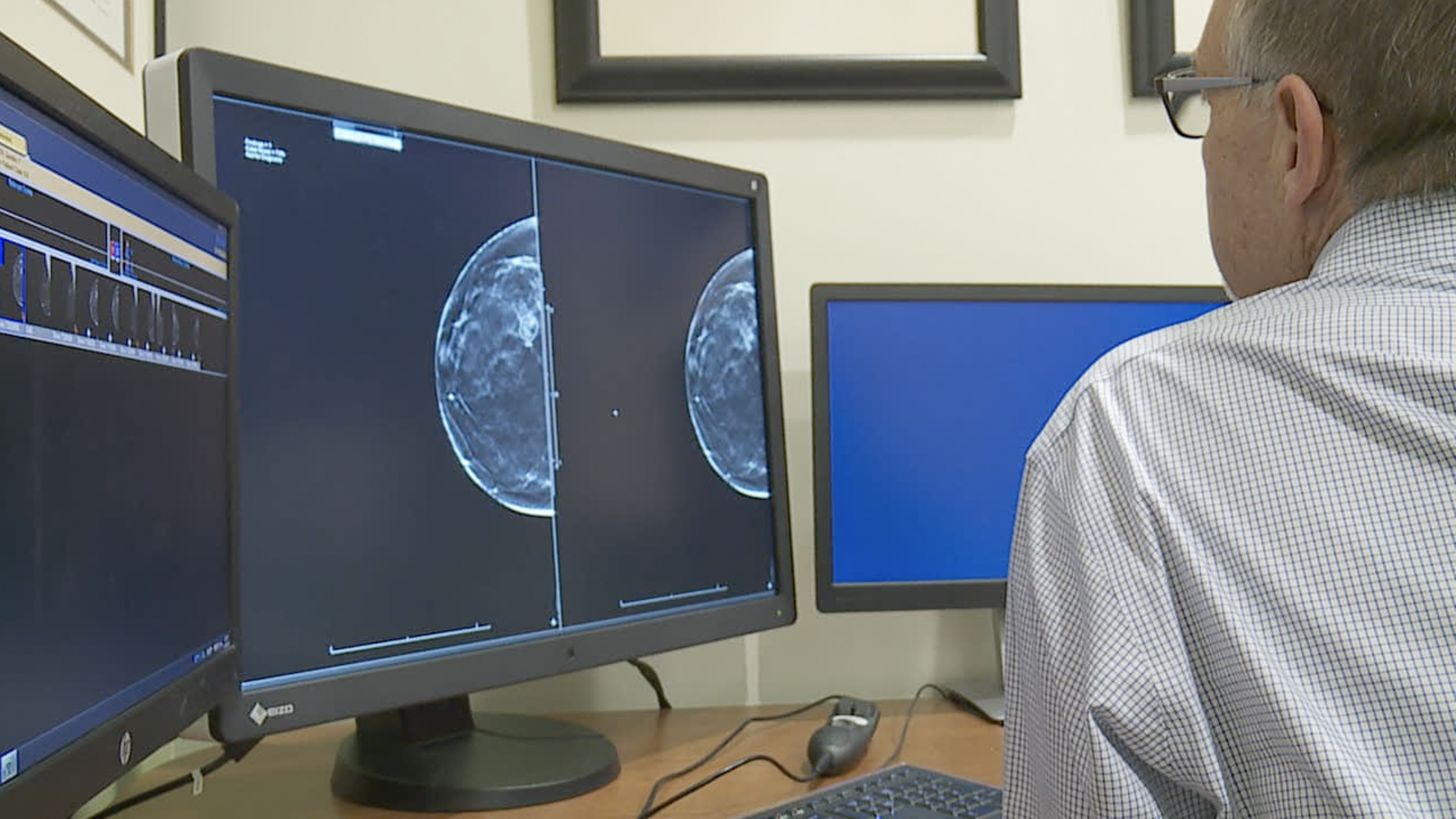 Breast cancer AI technology