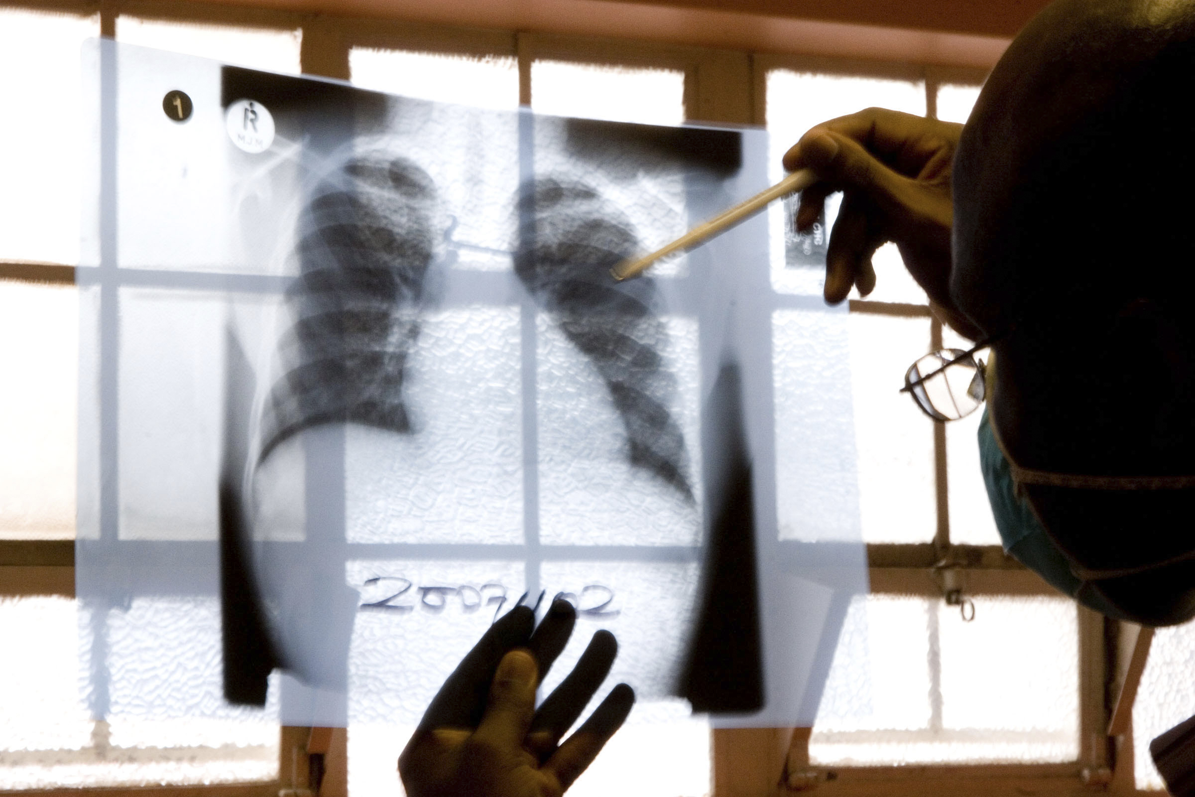 South Africa Tuberculosis