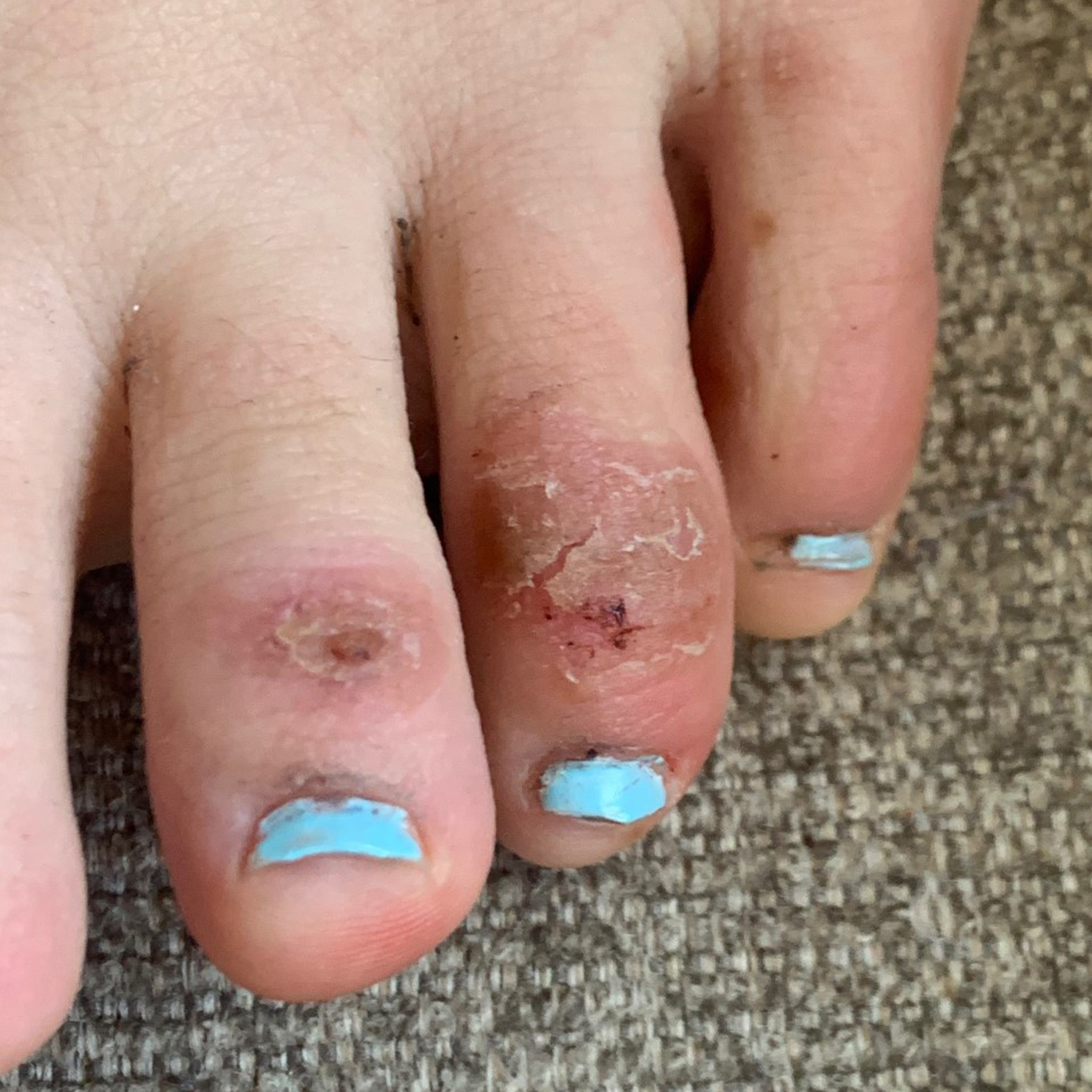 'COVID toes,' other rashes latest possible rare virus signs