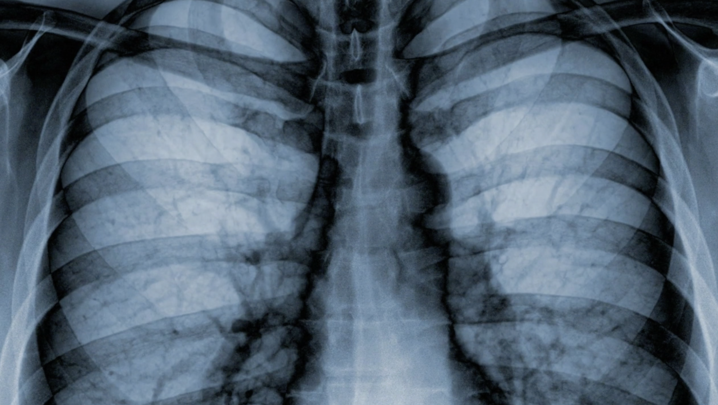 Respiratory illness