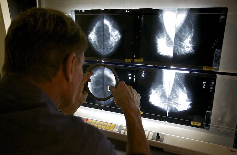 Breast Cancer Menopause Hormones