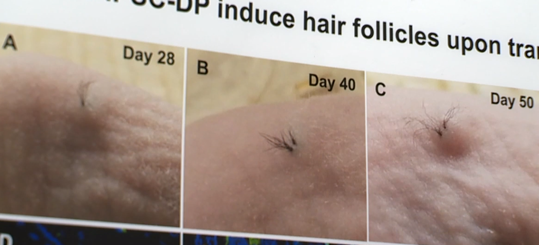 Stemson hair growth.png