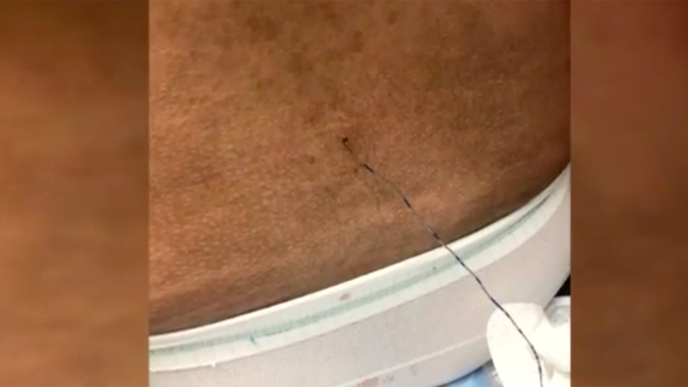 Epidural stuck in Selena Gray's back.