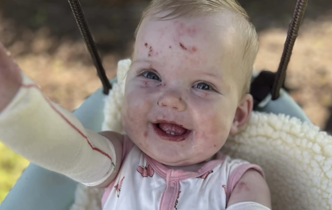 Milwaukee Mother Advocates for Rare Genetic Skin Disorder Awareness and Research