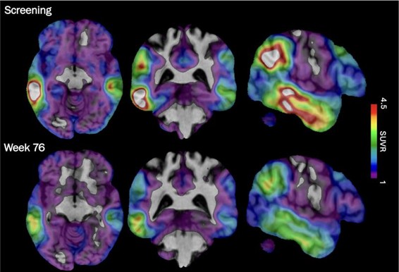 These brain scan images provided by Biogen show how high levels of Alzheimer's-related tau protein, in red, dropped in a recipient of the company's experimental drug diranersen. 