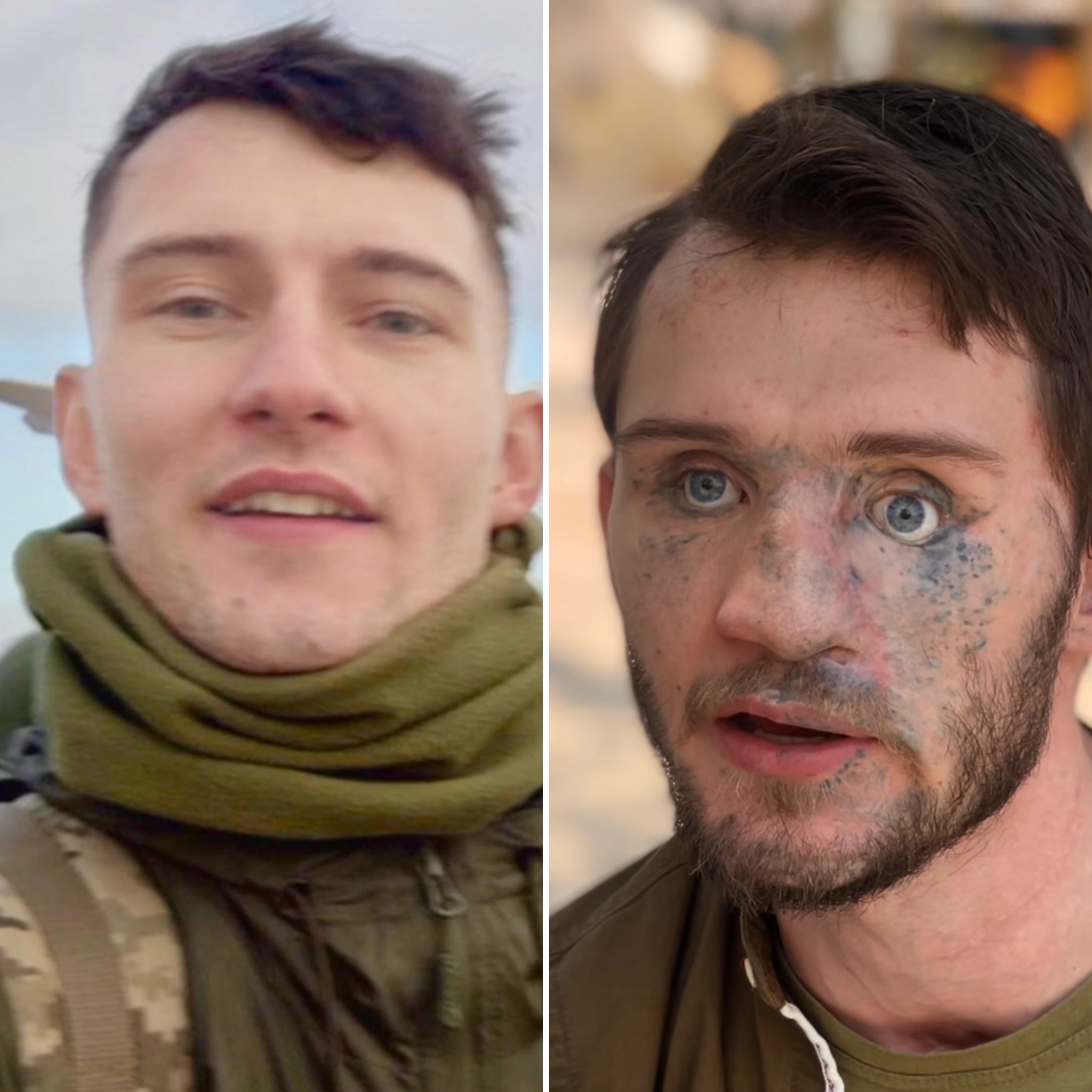 Before and after photos of Andrii Smolensky, wounded by a Russian kamikaze drone.