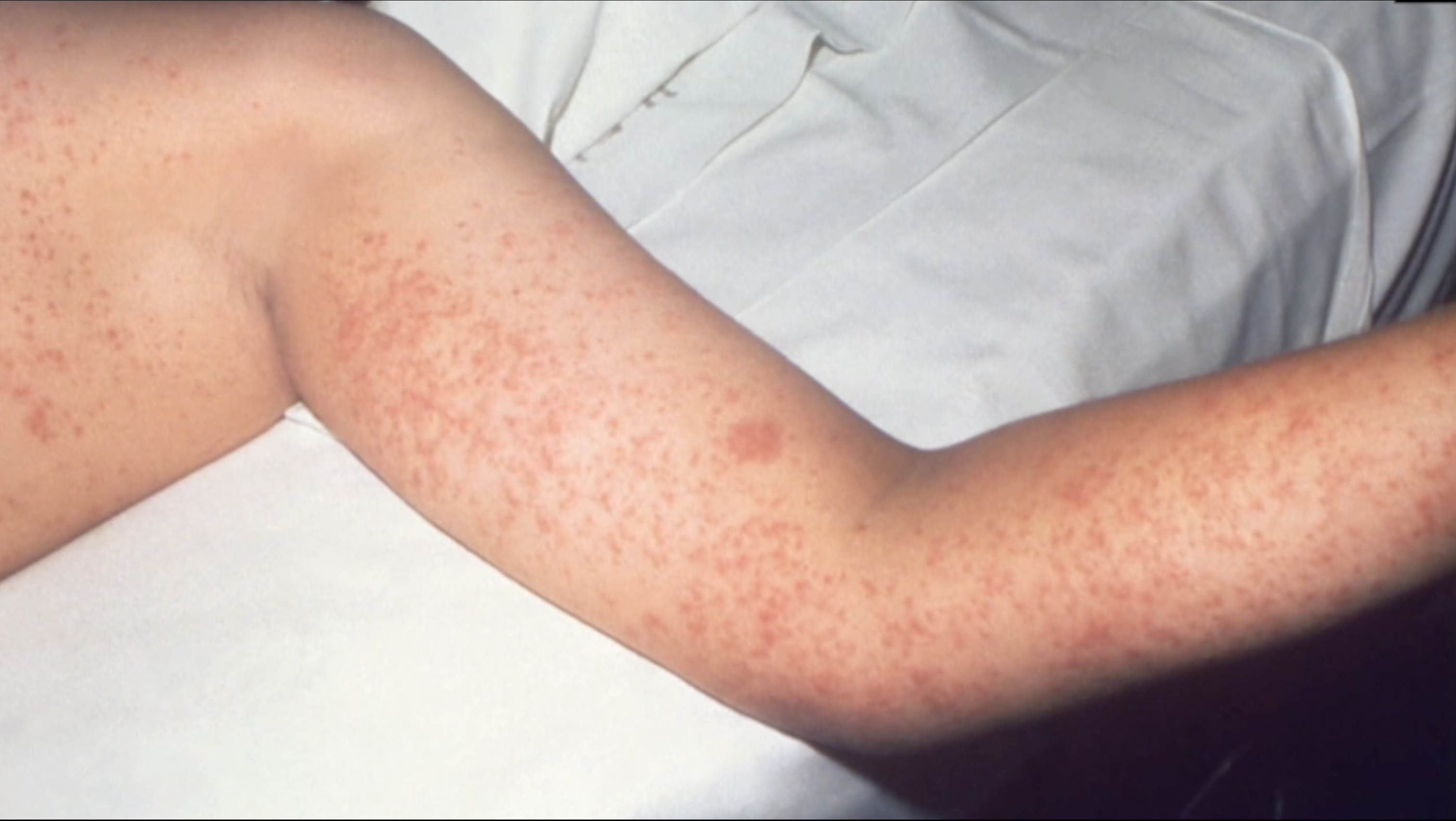 Measles patient
