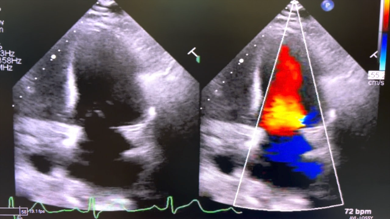 Echocardiography of a transplanted heart.png
