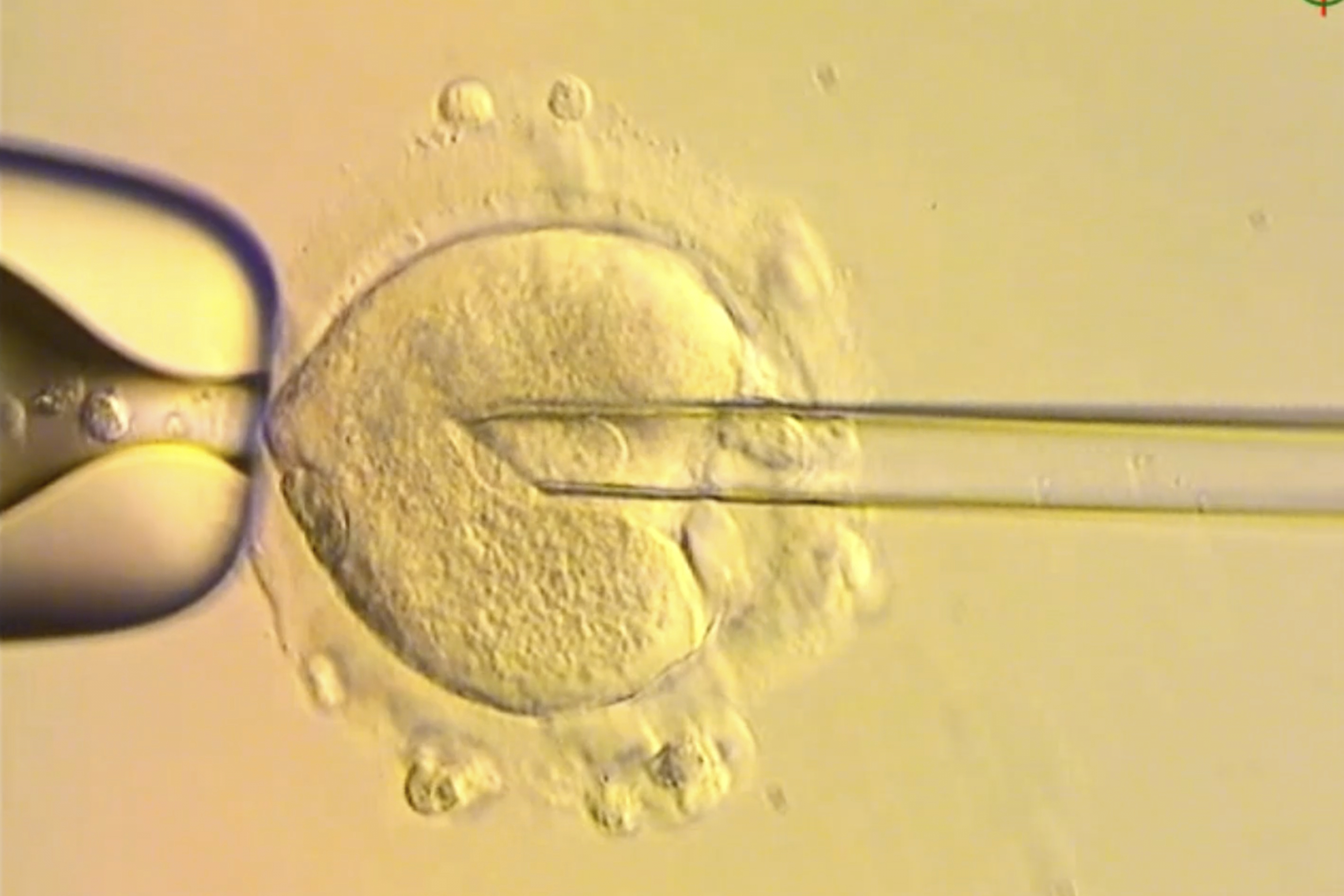 This image from video provided by the Newcastle Fertility Centre shows a nuclear genome from an egg carrying a mitochondrial DNA mutation being inserted into an egg donated by an unaffected woman.