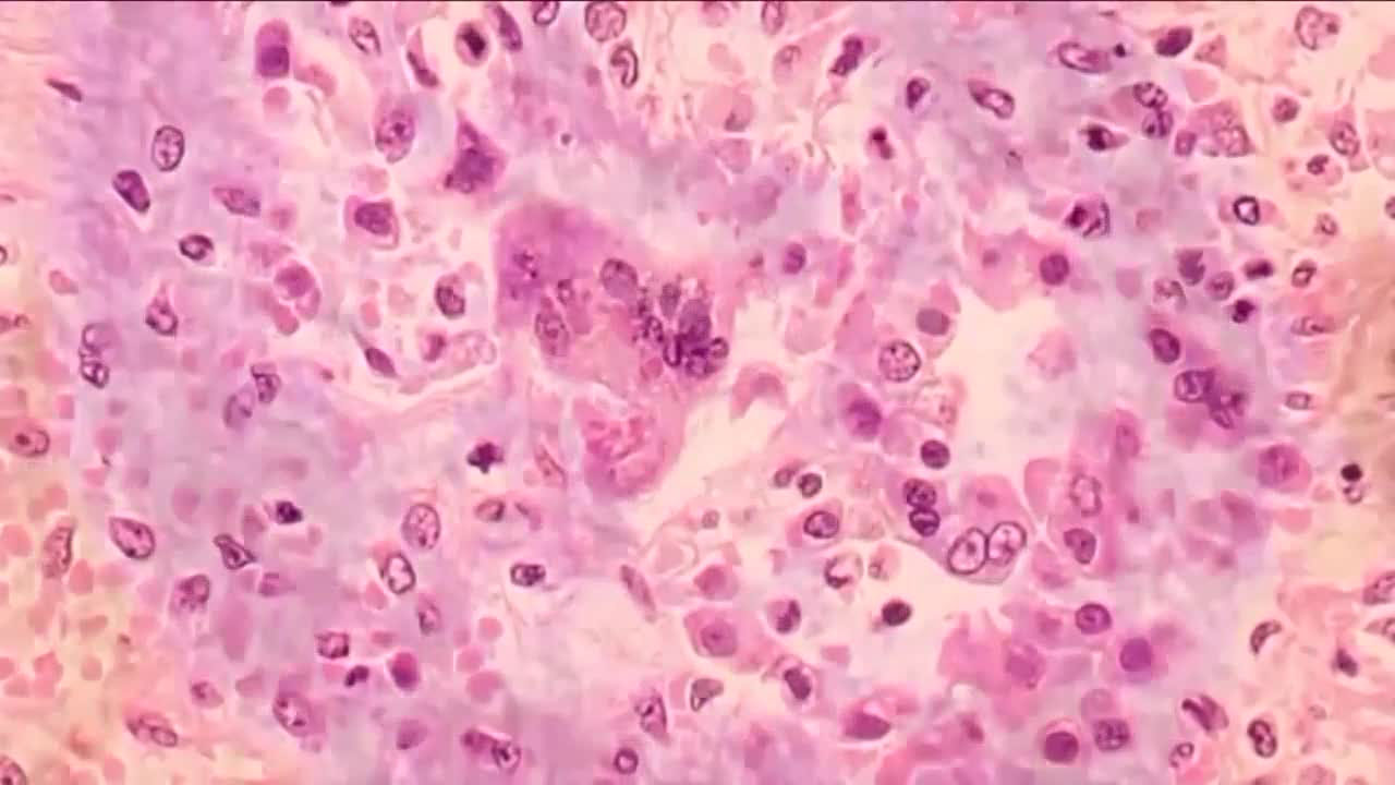 wptv-measles-.jpg