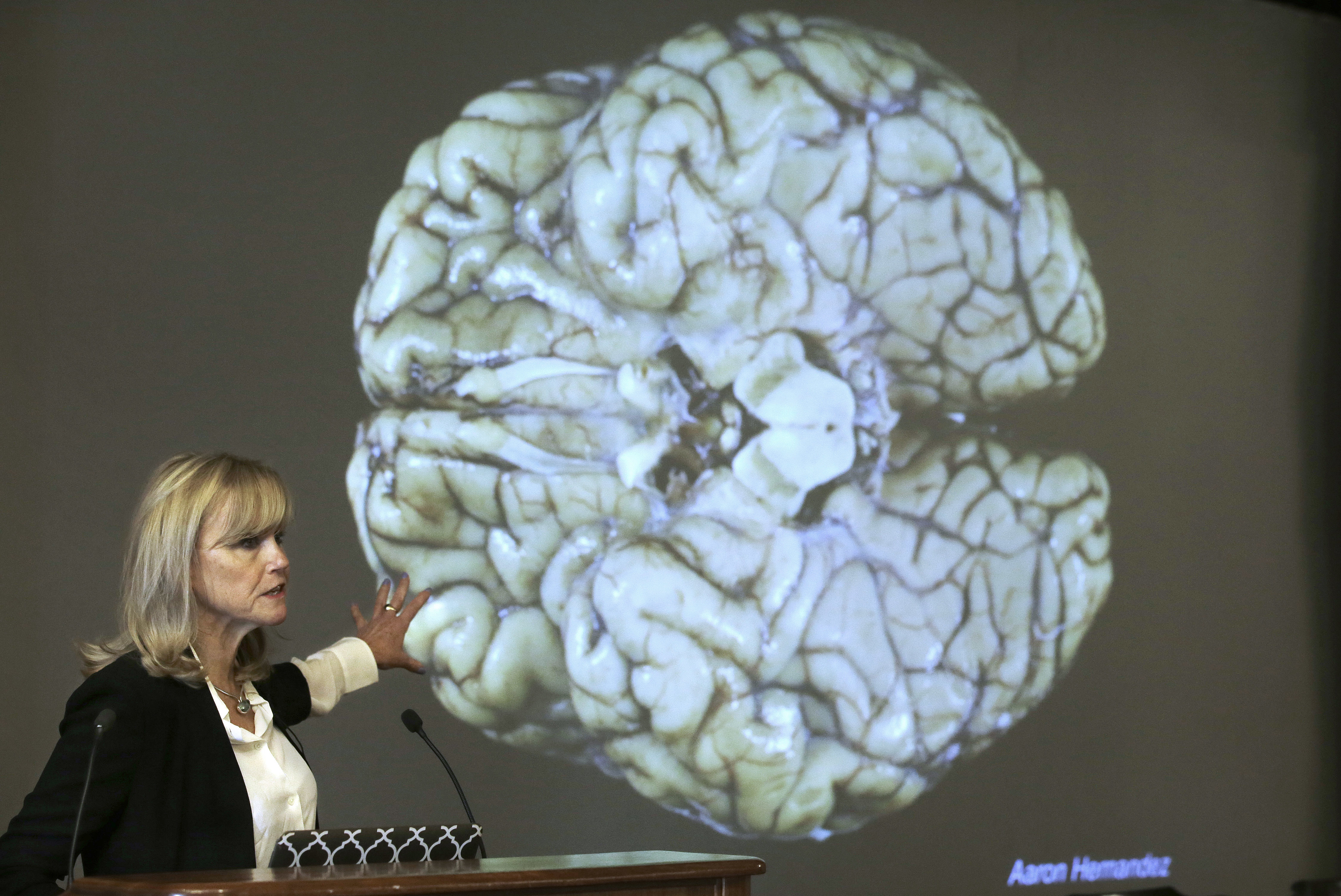 brain concussion AP