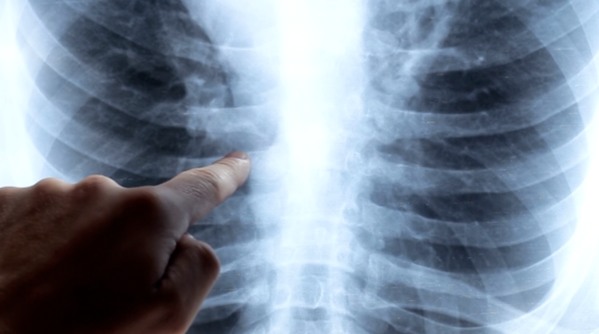 Respiratory infection lungs x-ray 