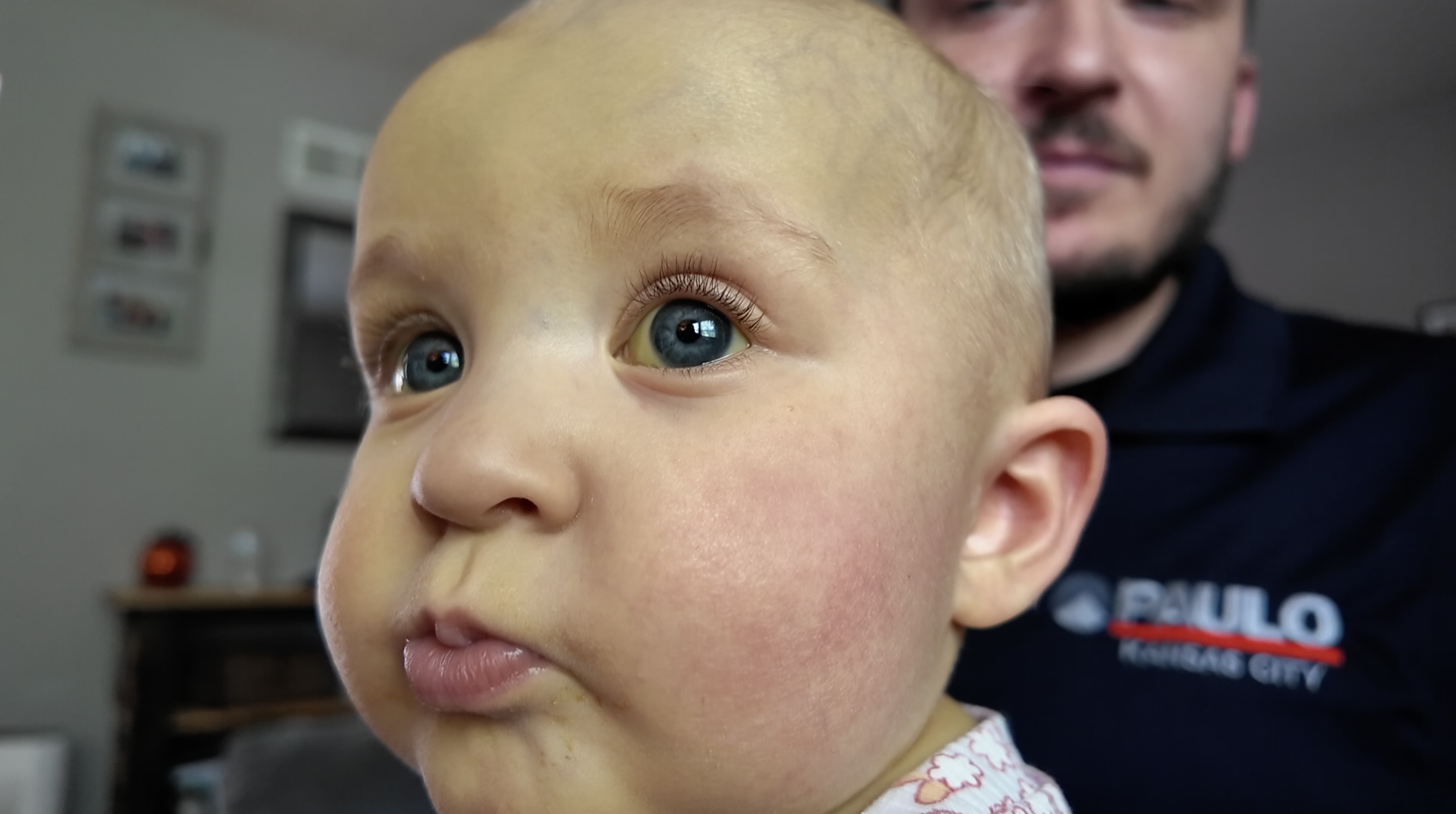 8-month-old Olivia liver transplant patient