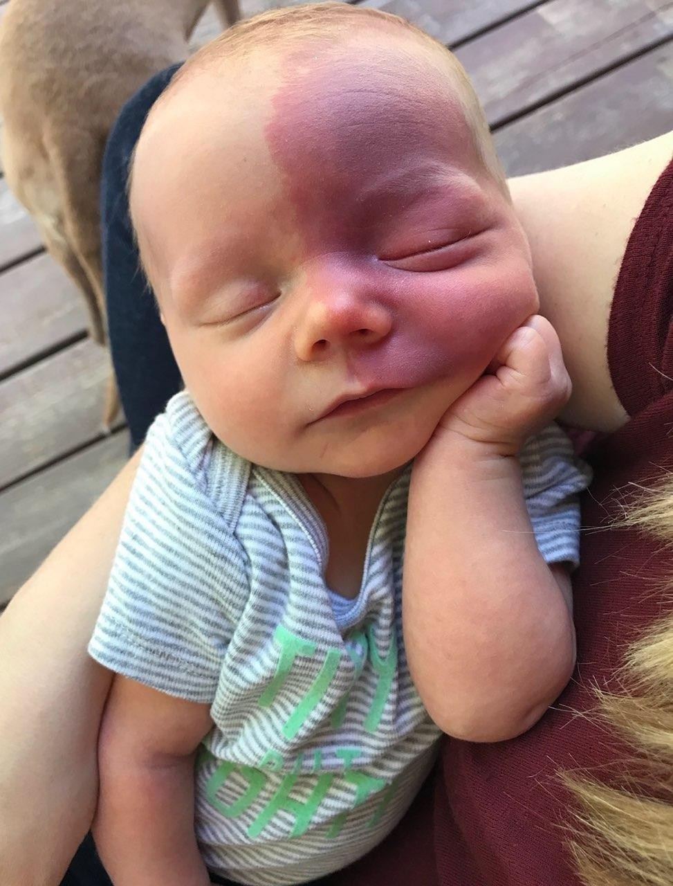 Birthmark baby.jpg