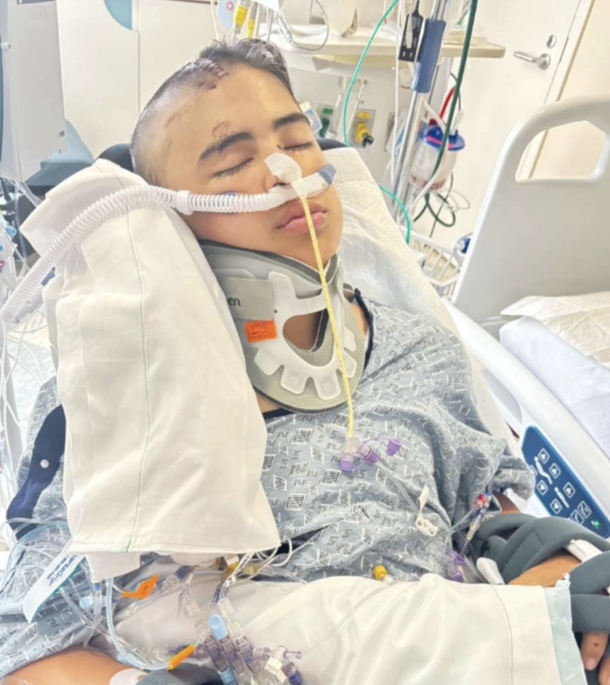  Carmel Valley e-bike crash victim, 12, moved out of ICU amid community support