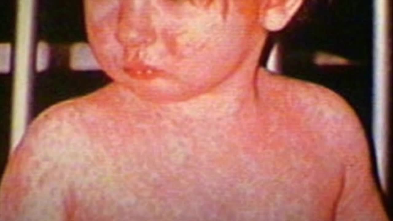Measles 02.jpg