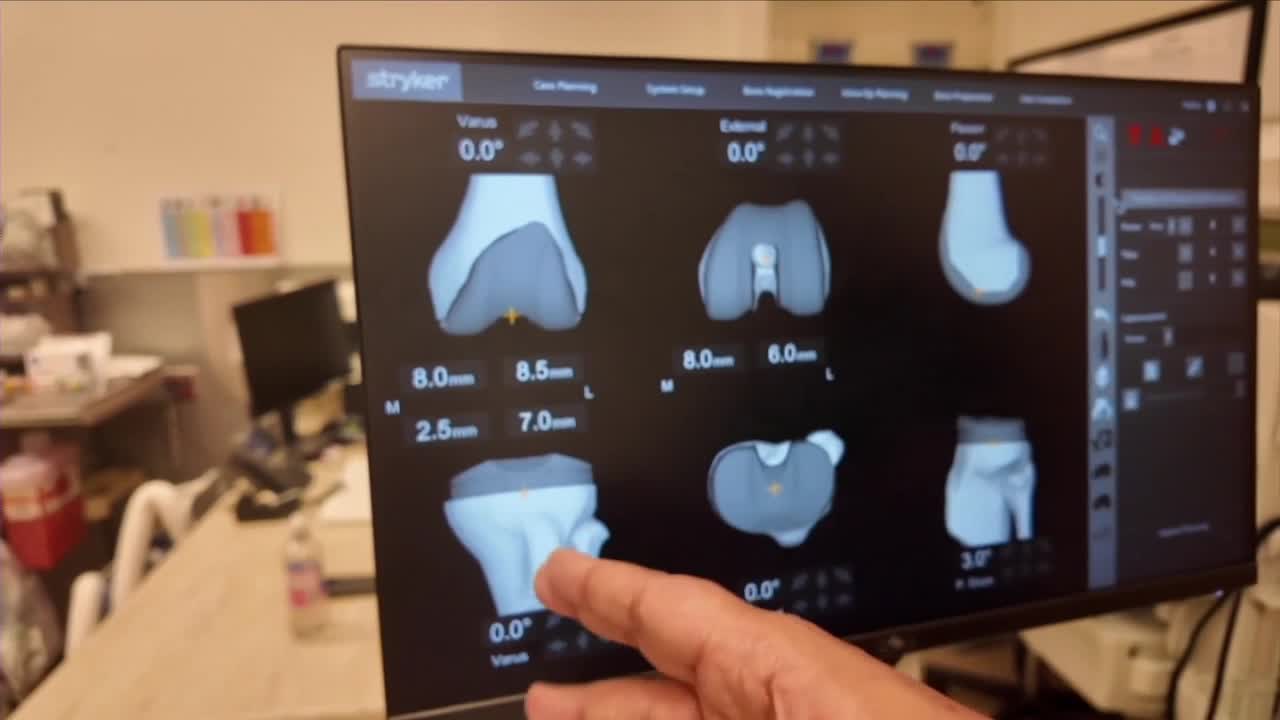 Osteoarthritis can be seen in Xrays