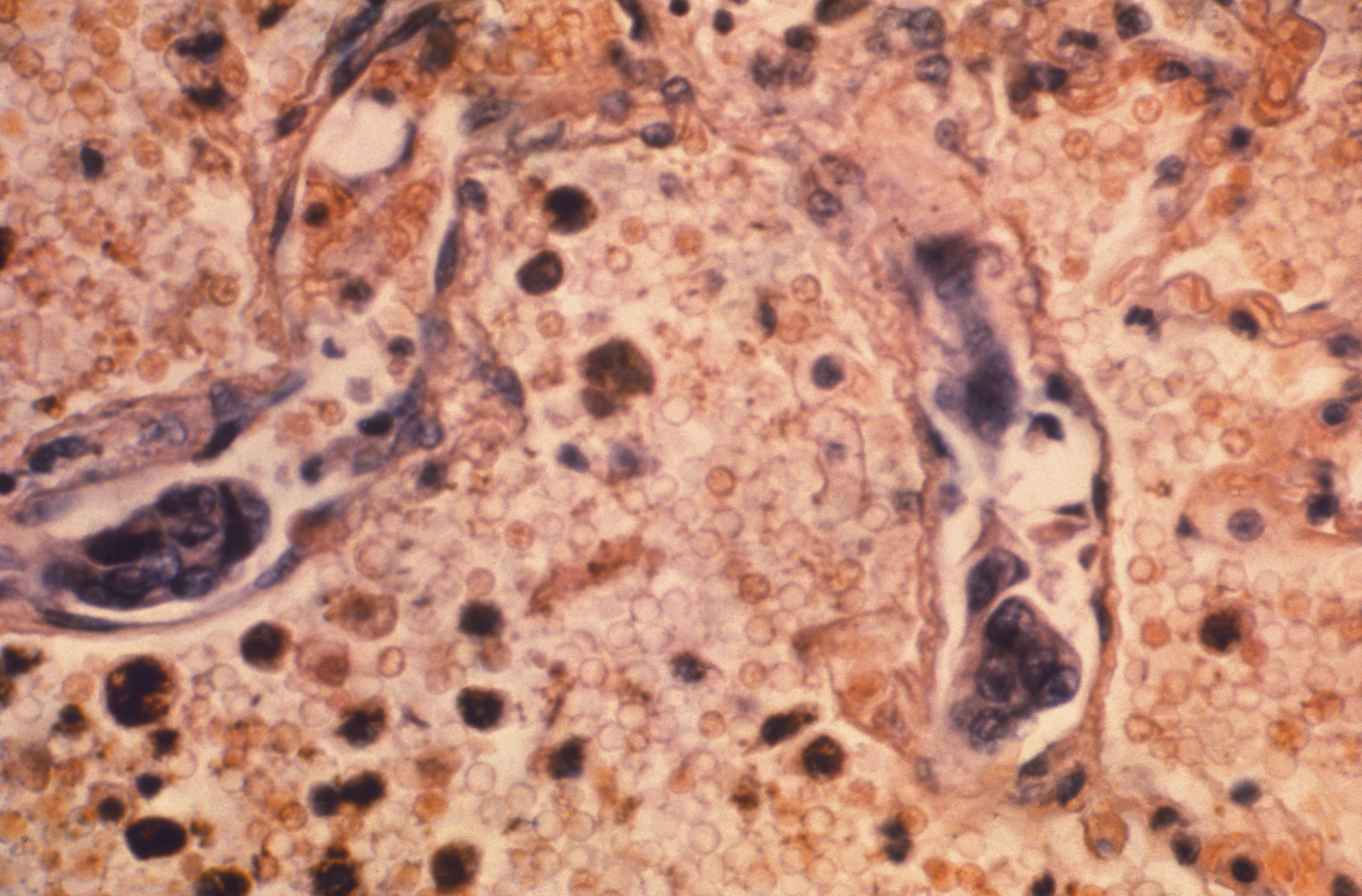 Lung Cancer