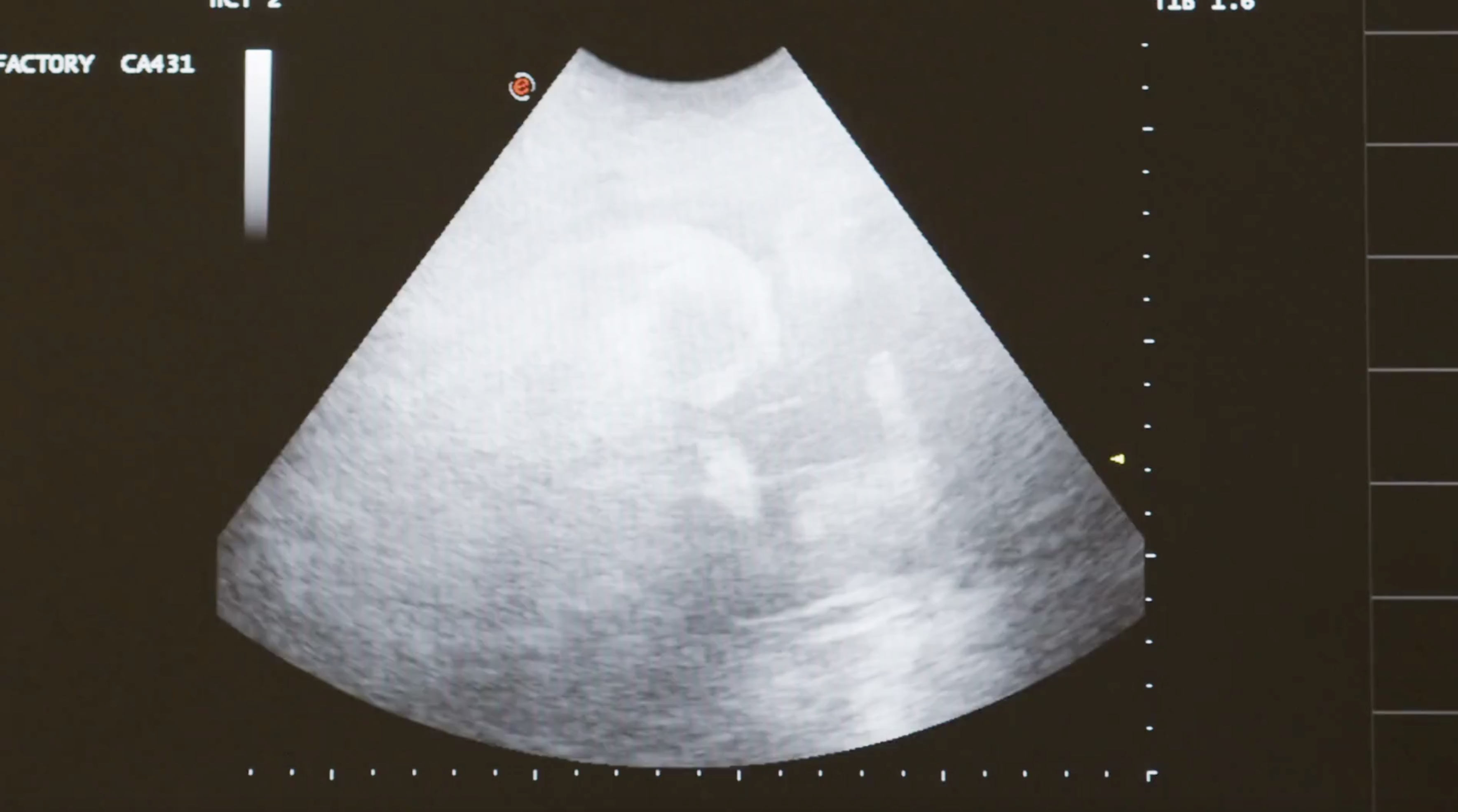 miscarriages