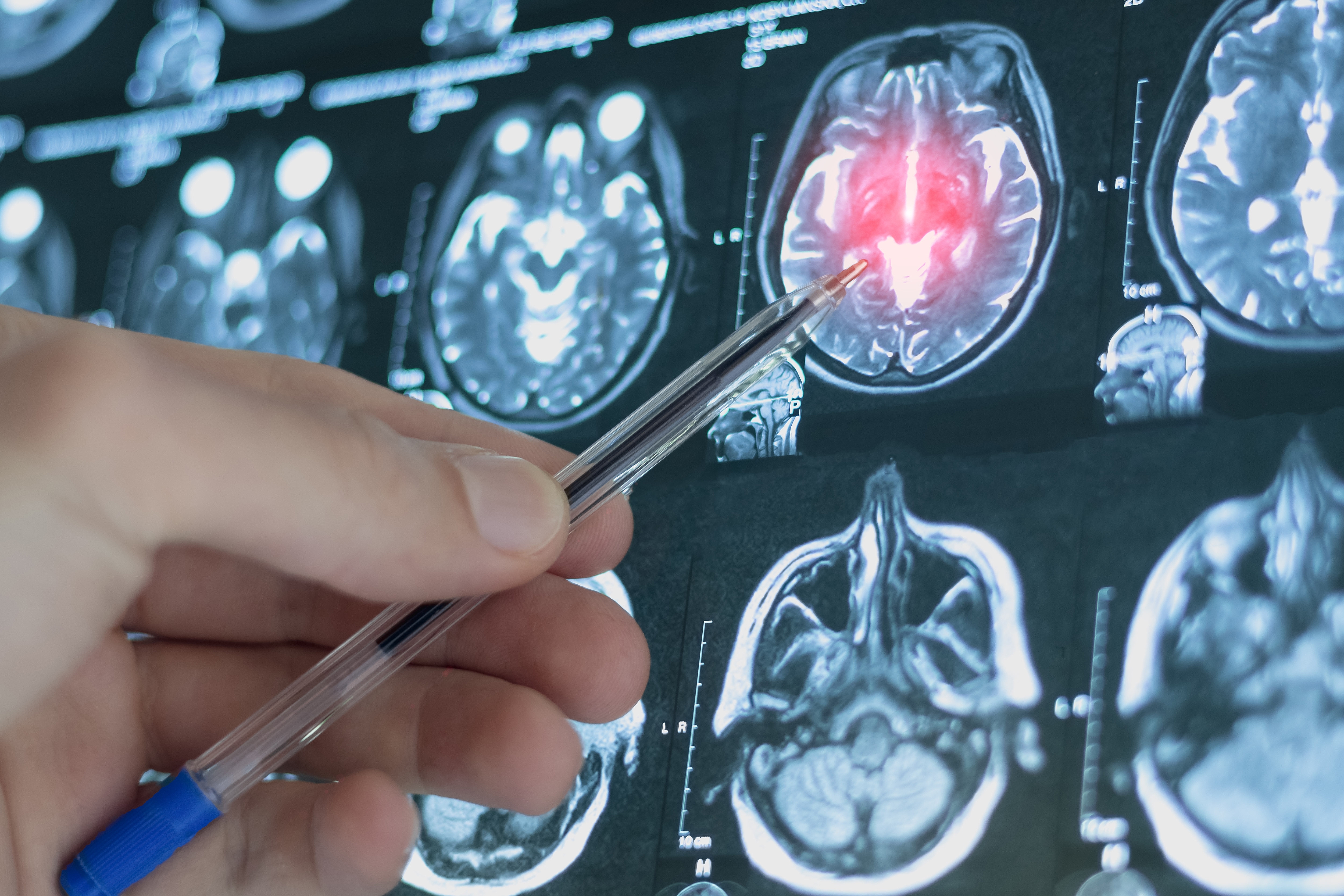 CT scans of a person's brain.