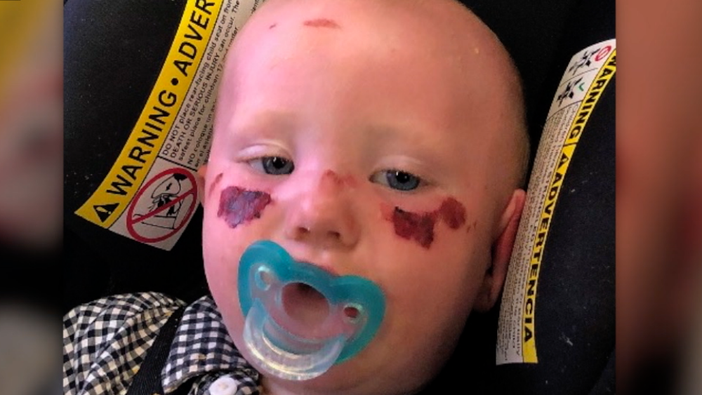 baby with sunblock burns