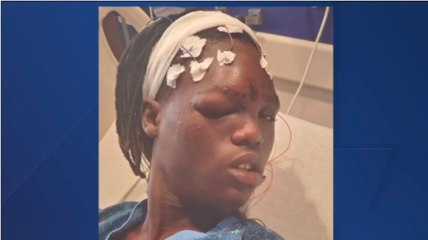 Mom speaks after teen son shot with rubber bullet following unrest