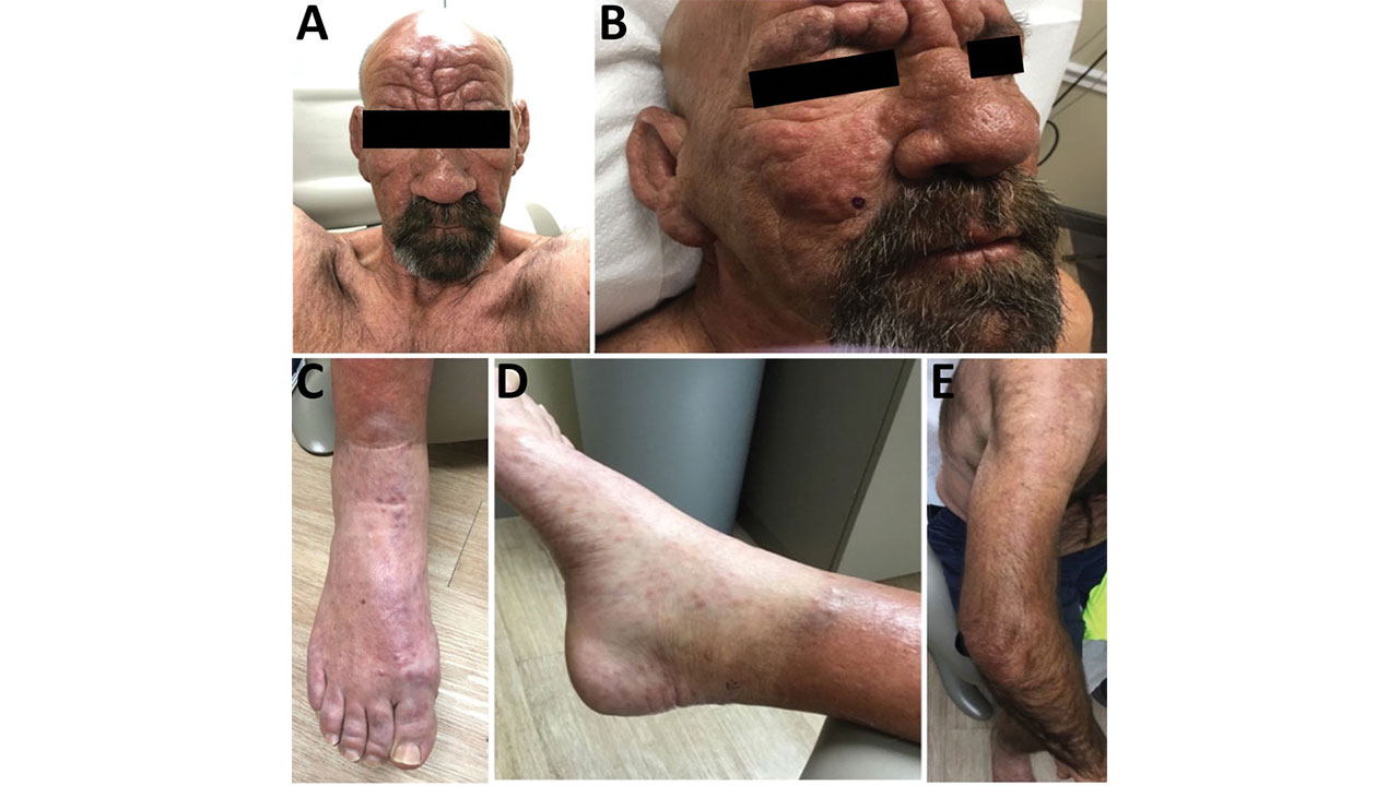 leprosy in 54-year-old central Florida man