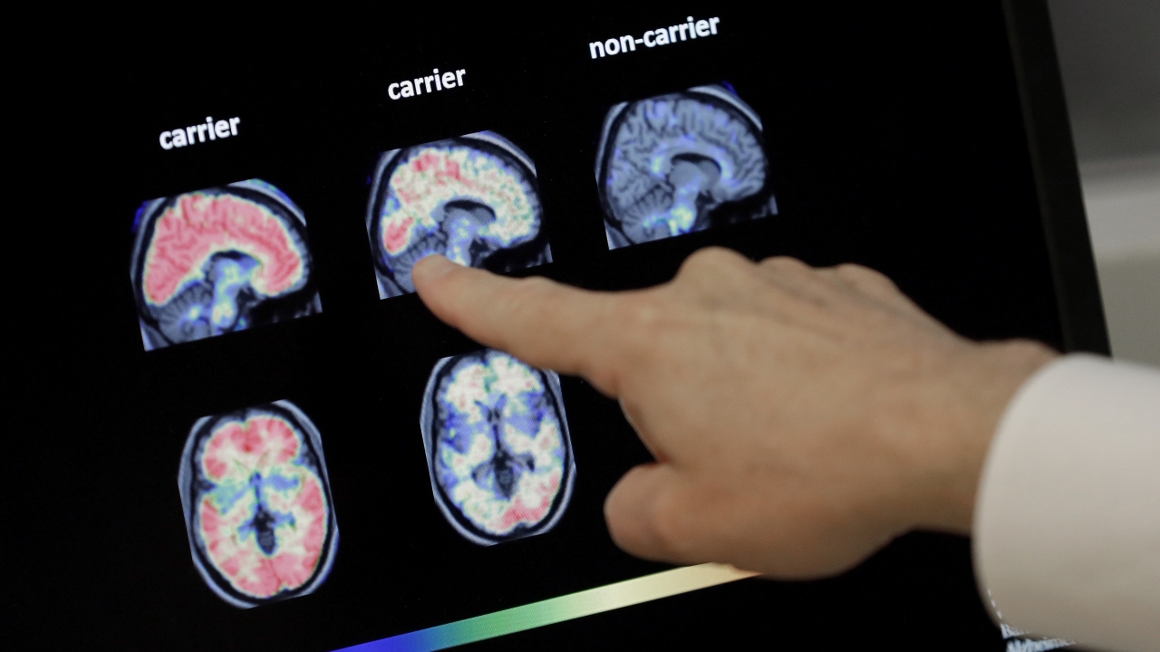 In this Aug. 14, 2018 file photo, a doctor looks at PET brain scans in Phoenix.