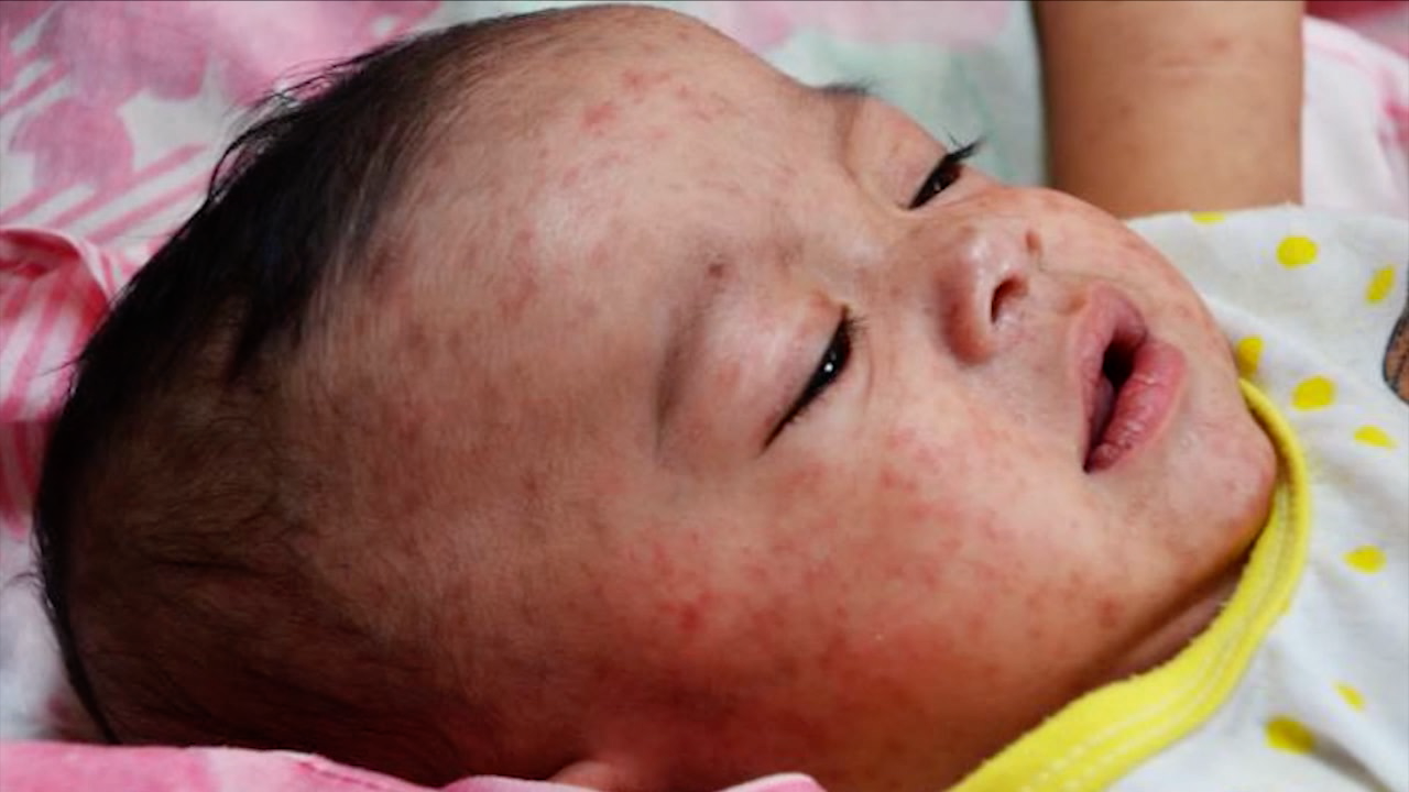 Ohio doctor: Misinformation contributing to state's measles outbreak - Vimarsana News