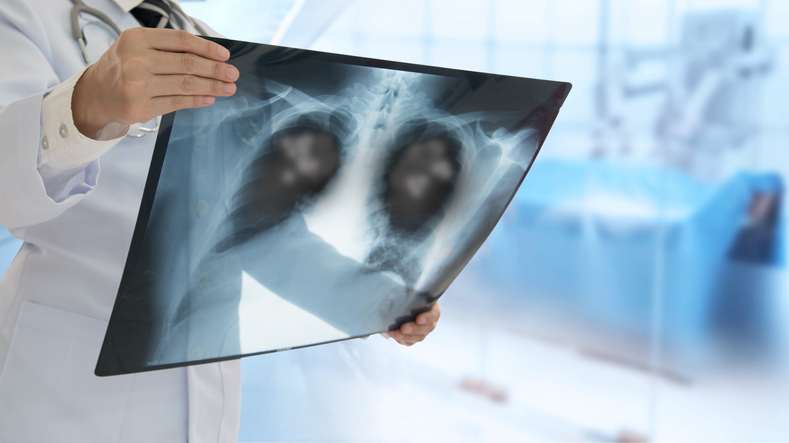 Pneumonia patient x-ray