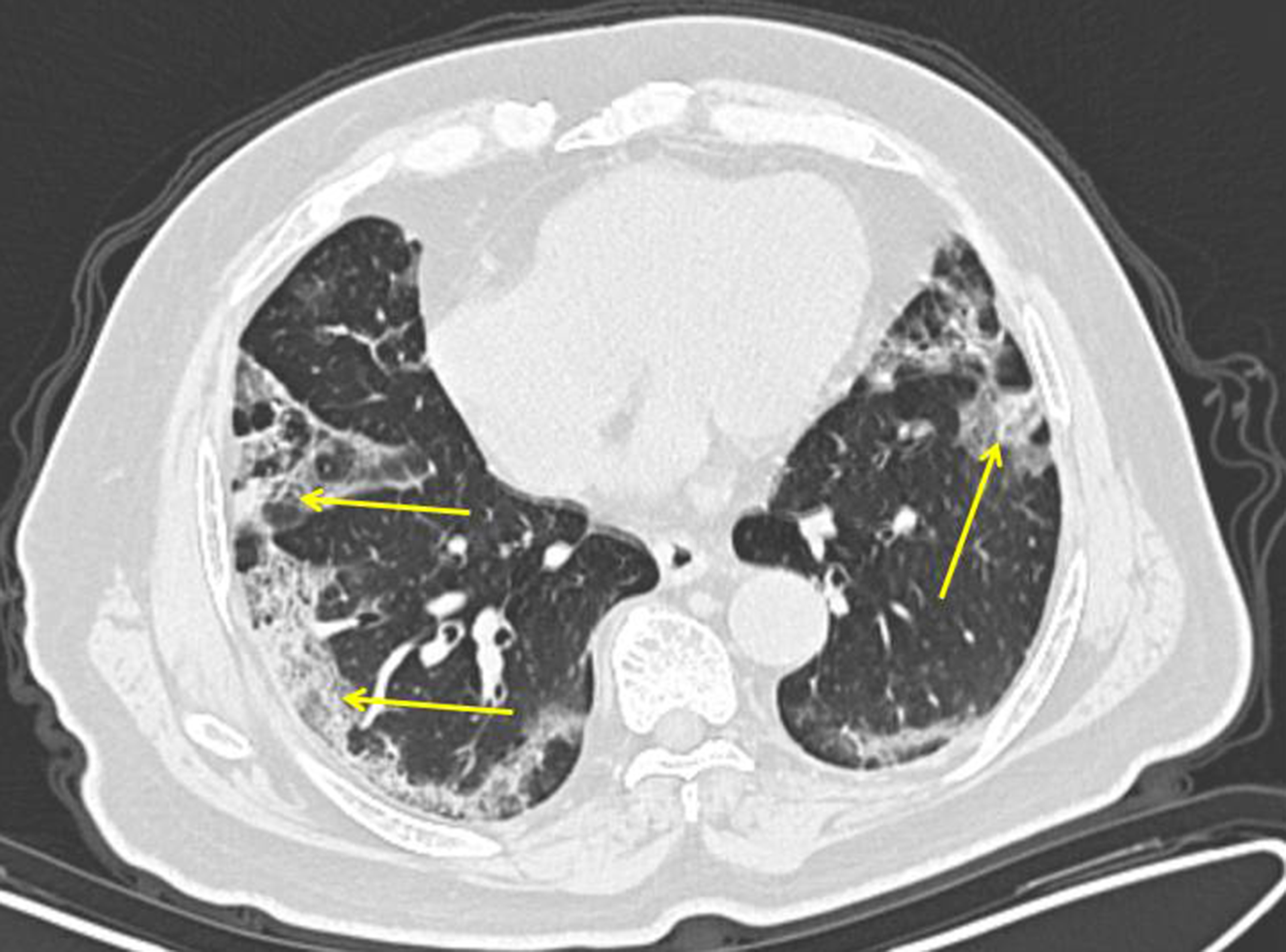 COVID-19 lung patterns show few clues for treating pneumonia