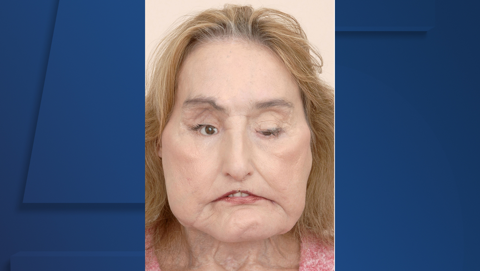 Connie Culp, first patient in the US to receive partial face transplant, dies at 57