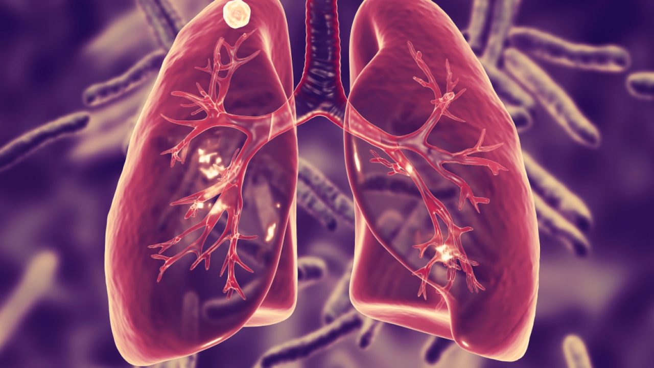 3D illustration of tuberculosis in lungs