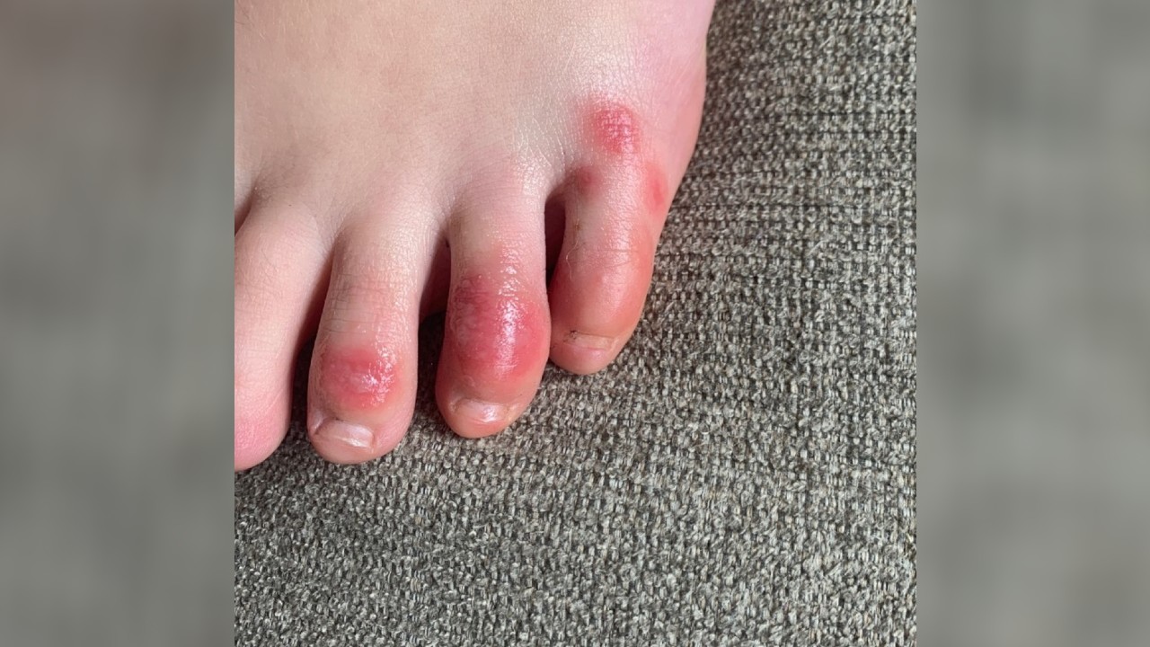 Doctors say 'COVID toes' may be symptom of coronavirus, especially in youth