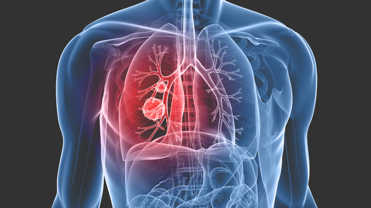 Lung Cancer (FILE)