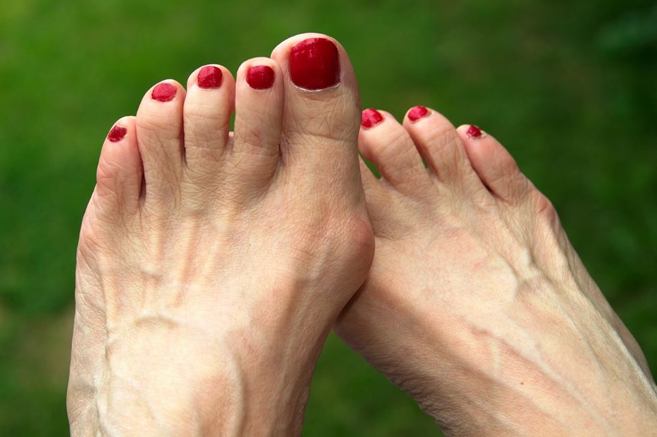 heal varicose foot