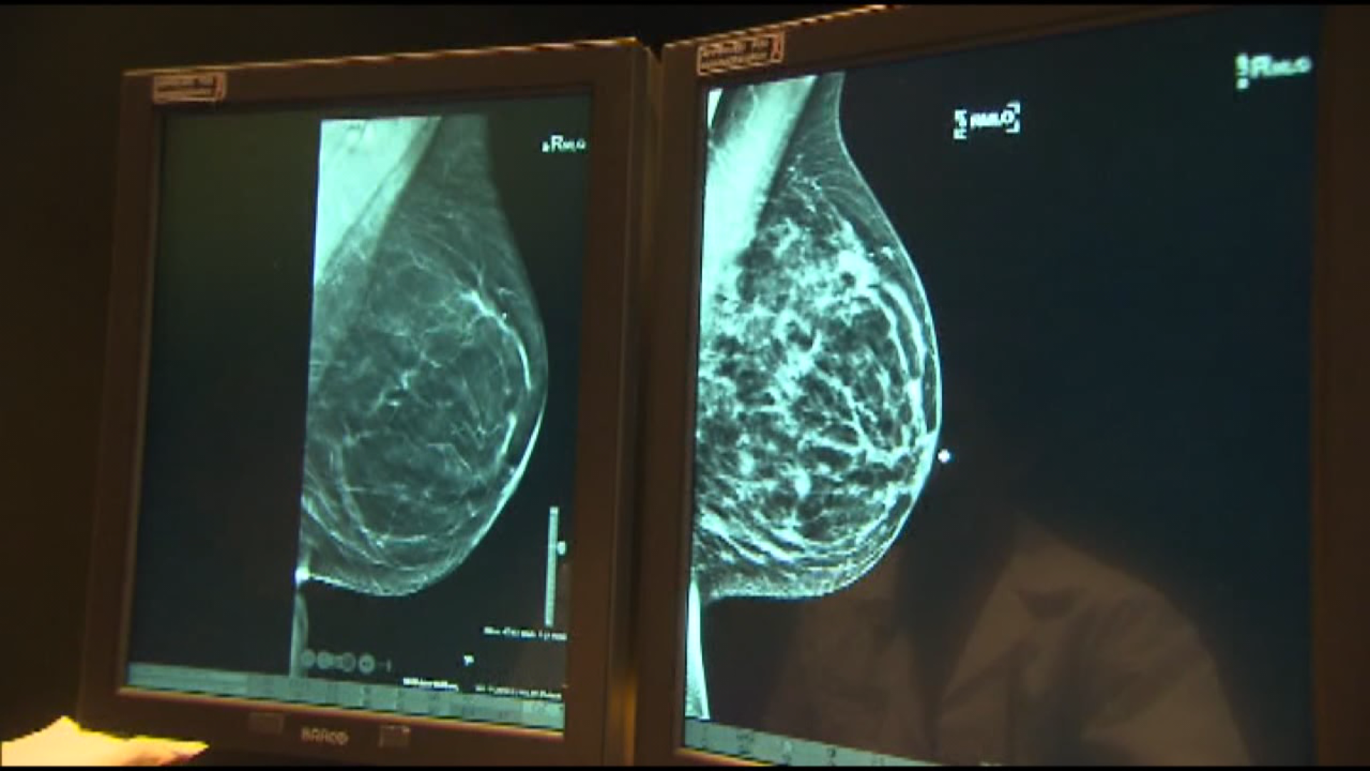 Fda Proposes Changes To Mammogram Guidelines