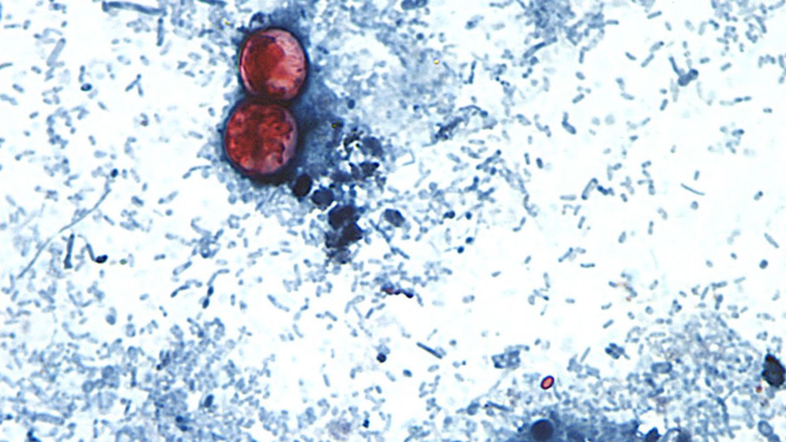 Cyclosporiasis