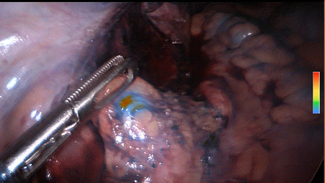 Ovarian cancer surgery