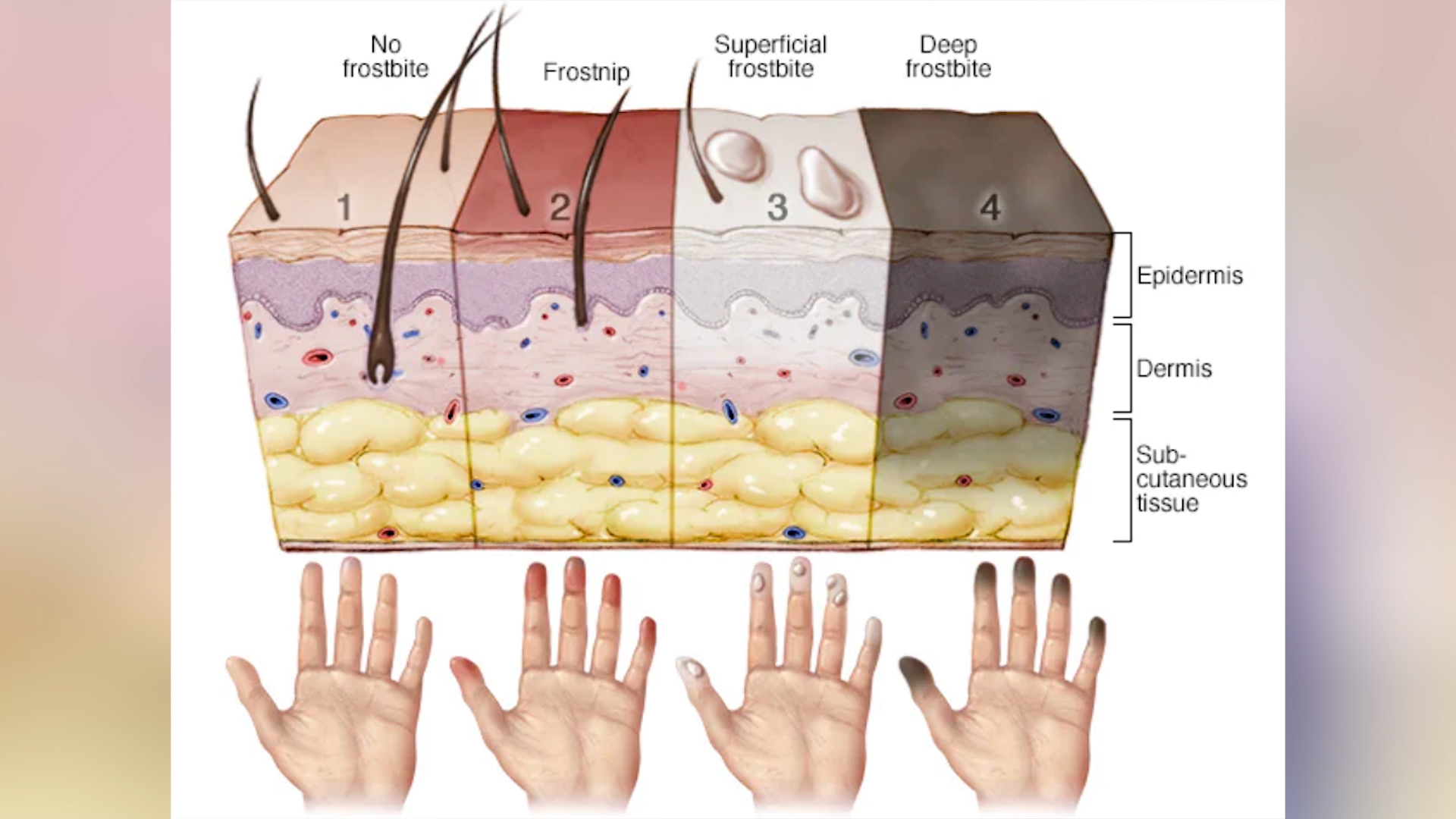 Stages of Frostbite (Mayo Clinic).jpg